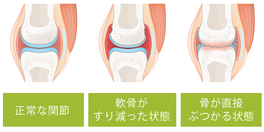 変形性膝関節症の画像
